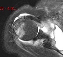 Figure 2 for case amyloid arthropathy ( RID5188 )